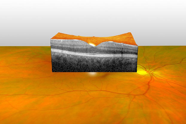 Bild einer Optische-Cohärenz-Tomographie (OCT)