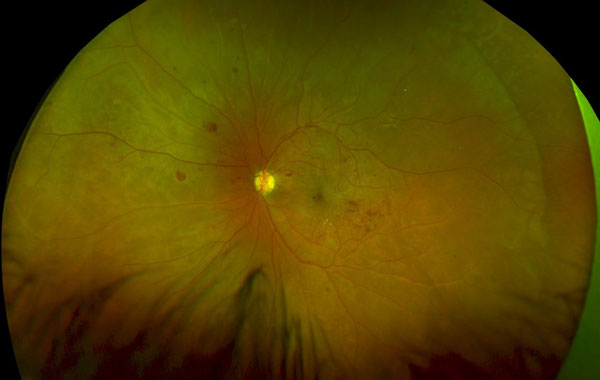 Augenhintergrundveränderungen mit Blutungen und Gefäßausschwitzungen bei Diabetes mellitus